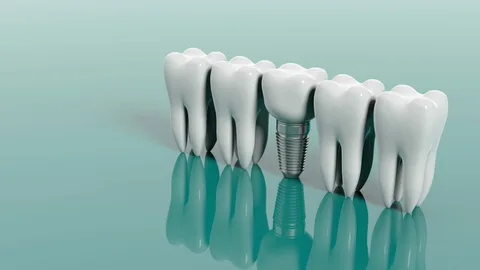 dental implants dental implants alexandria